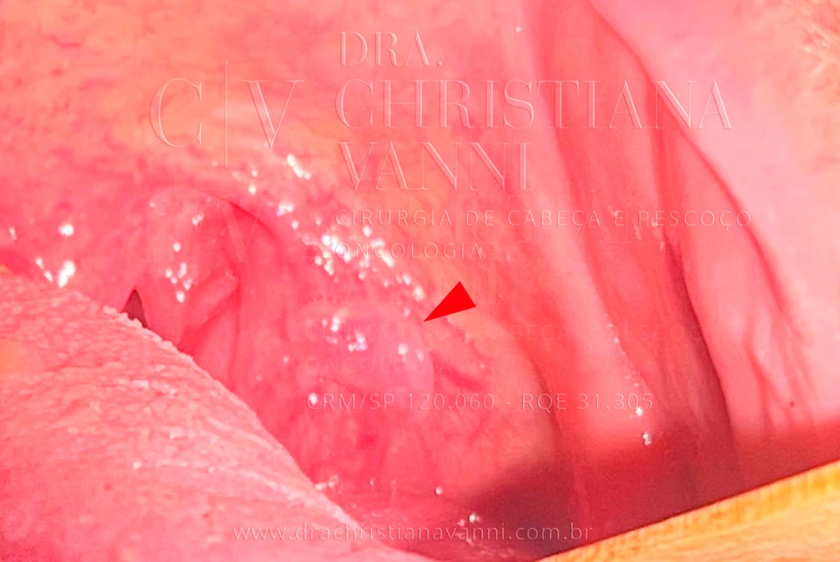 Carcinoma Espinocelular (CEC)