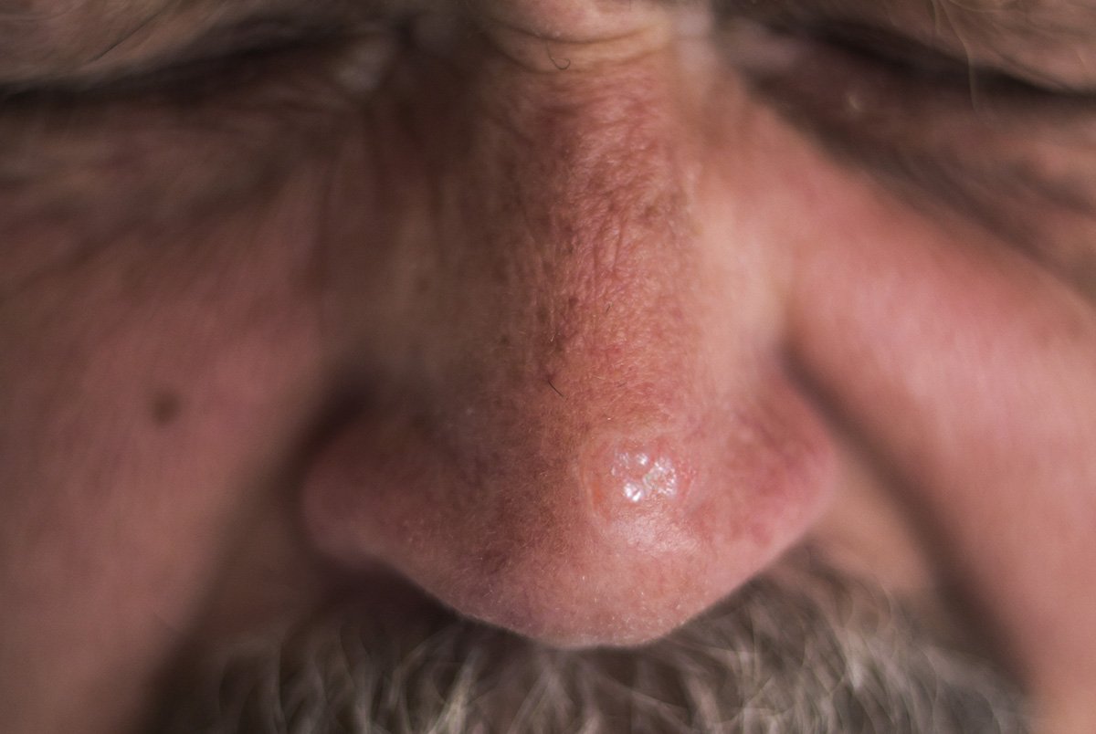 Carcinoma Basocelular
