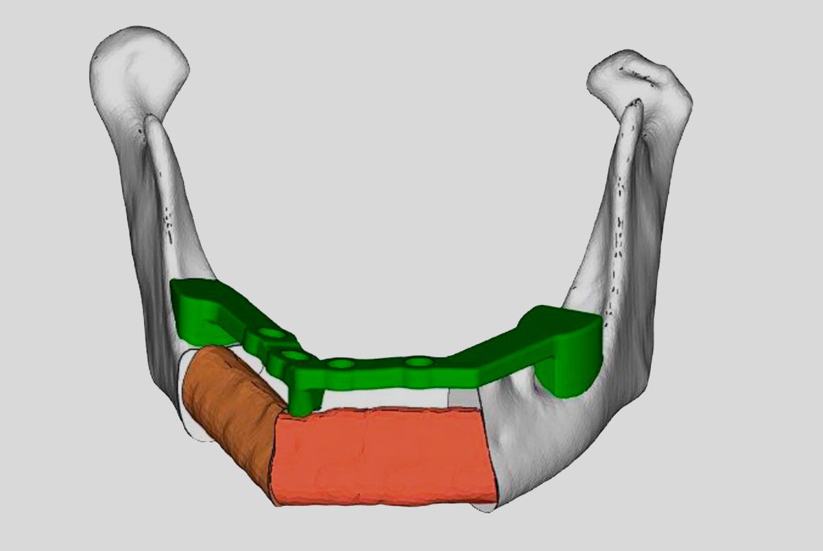 Cirurgia Oncológica com Reconstrução de Mandíbula