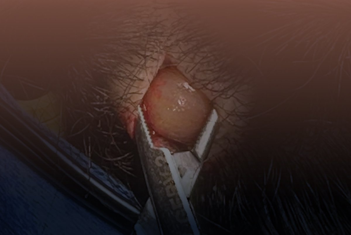 Cisto na Cabeça é Perigoso? Quando Procurar o Médico