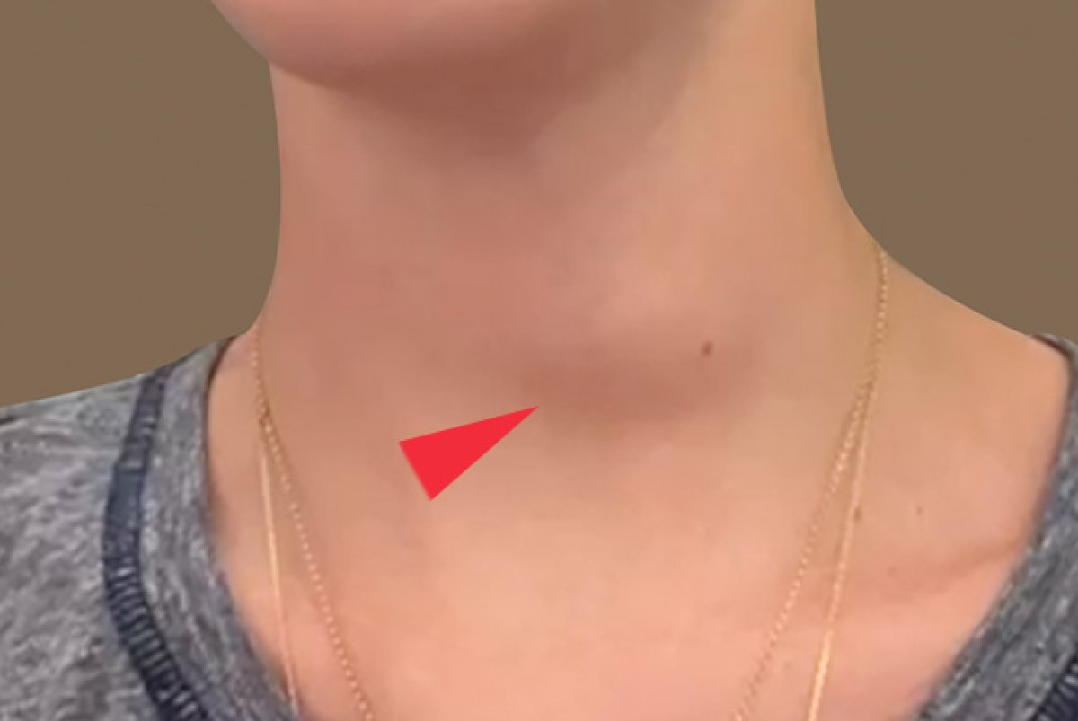 Doença De Plummer Tem Cura?