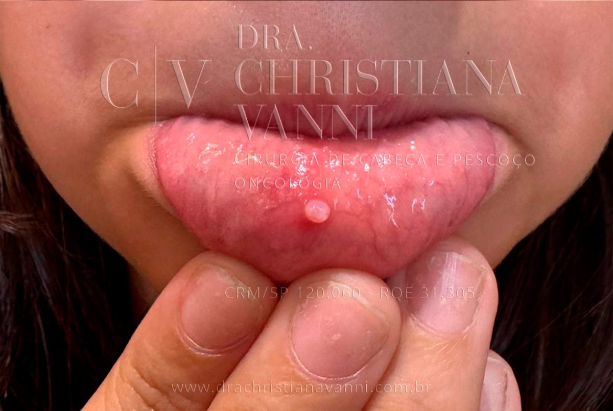 Fibroma na Boca: O que é e como tratar essa bolinha?
