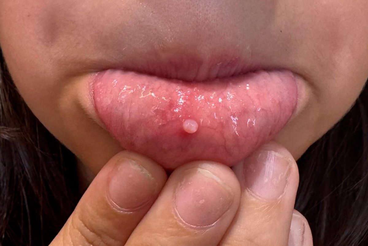 Fibroma na Boca: O que é e como tratar essa bolinha?
