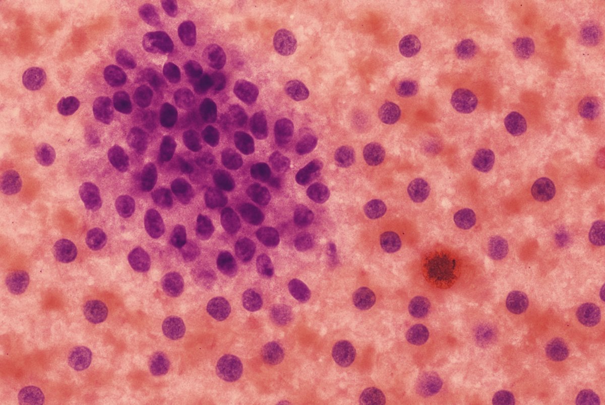 Lesão Folicular Bethesda IV: Significado e Tratamento