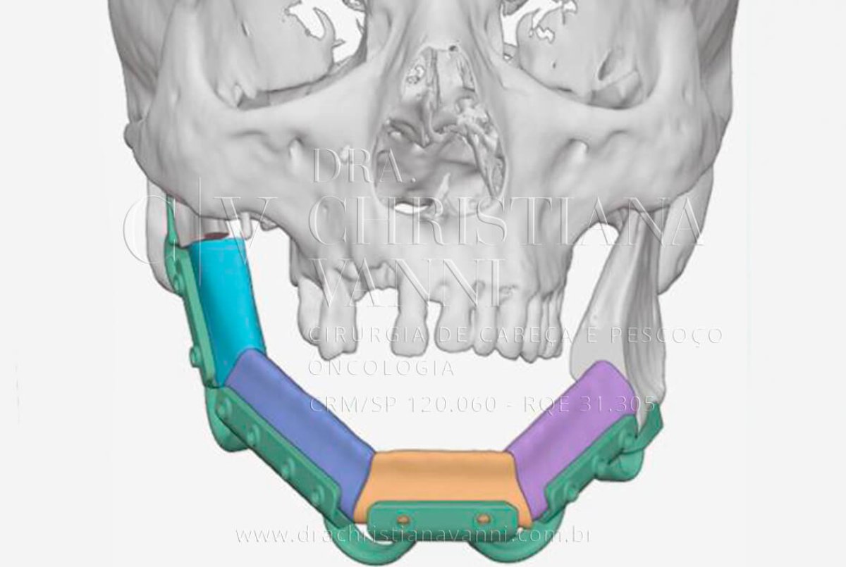 Tumor de Pele na Face: Cirurgia e Reconstrução