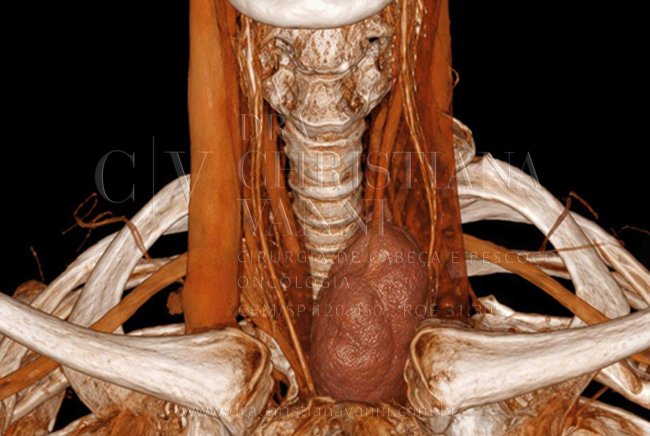 Cirurgia de Bócio Mergulhante: Indicações e Tratamento