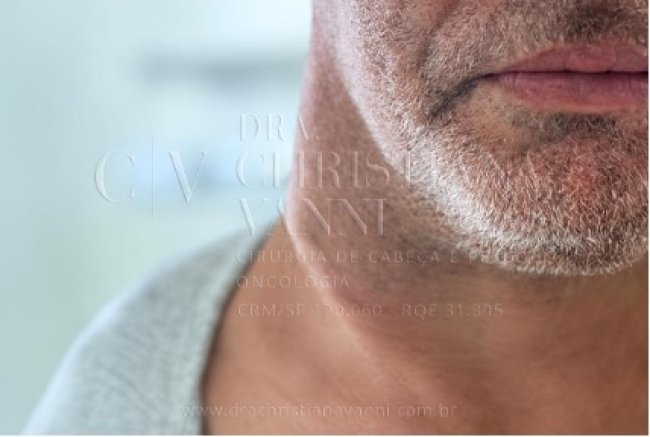 Caroço no Pescoço Qual Médico Procurar