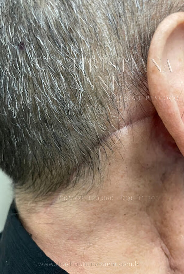cicatriz de cirurgia de tireoide por acesso retroauricular