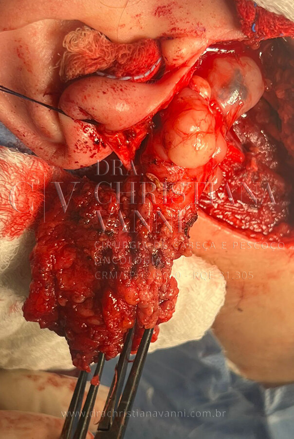 Cirurgia Oncológica de Parótida