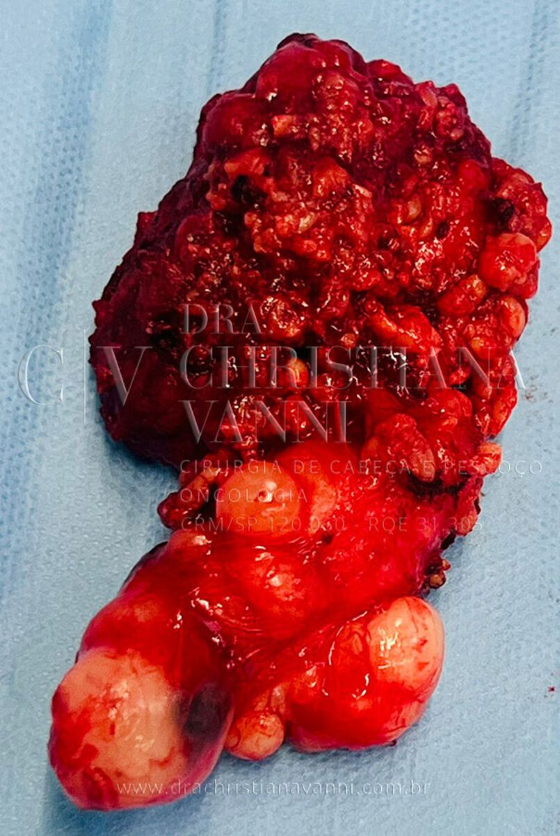 Foto de Tumor na Parótida