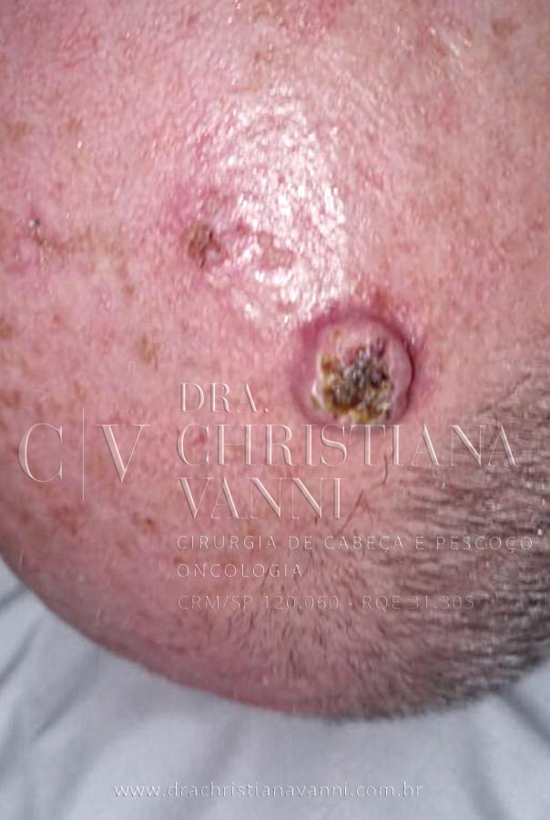 Carcinoma na cabeça - Tumor no couro cabeludo