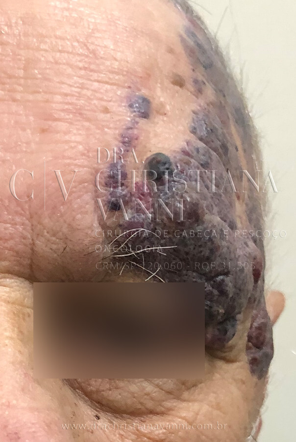 Melanoma - câncer no rosto