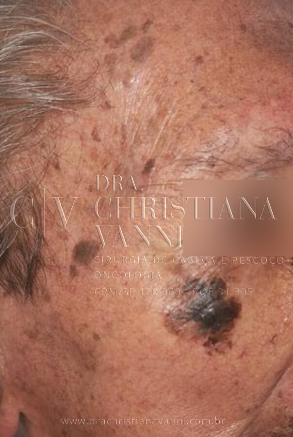 Melanoma no rosto