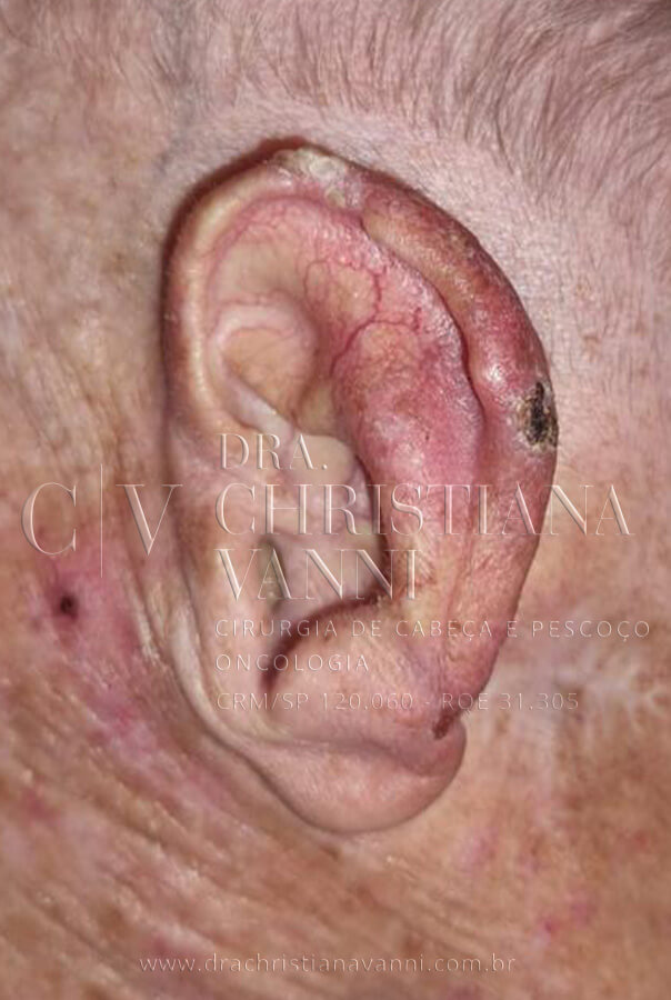 Foto de Carcinoma de Células Escamosas (câncer na orelha)