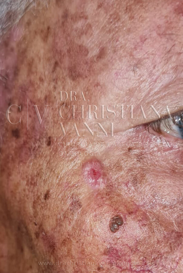 Foto de Carcinoma de Células Escamosas (câncer no rosto)