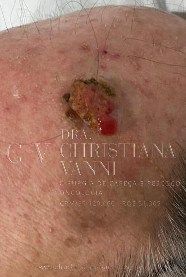 Foto de Carcinoma de Células Escamosas (câncer no couro cabeludo)