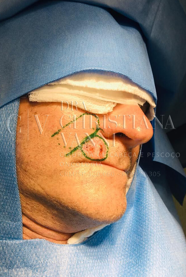 Foto de Carcinoma de Células Escamosas (câncer de pele no rosto)