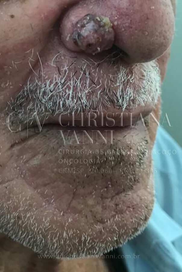 Foto de Carcinoma de Células Escamosas (câncer no nariz)