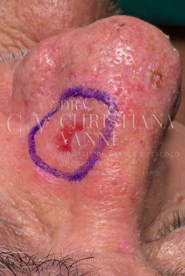 Cirurgia Micrográfica de Mohs