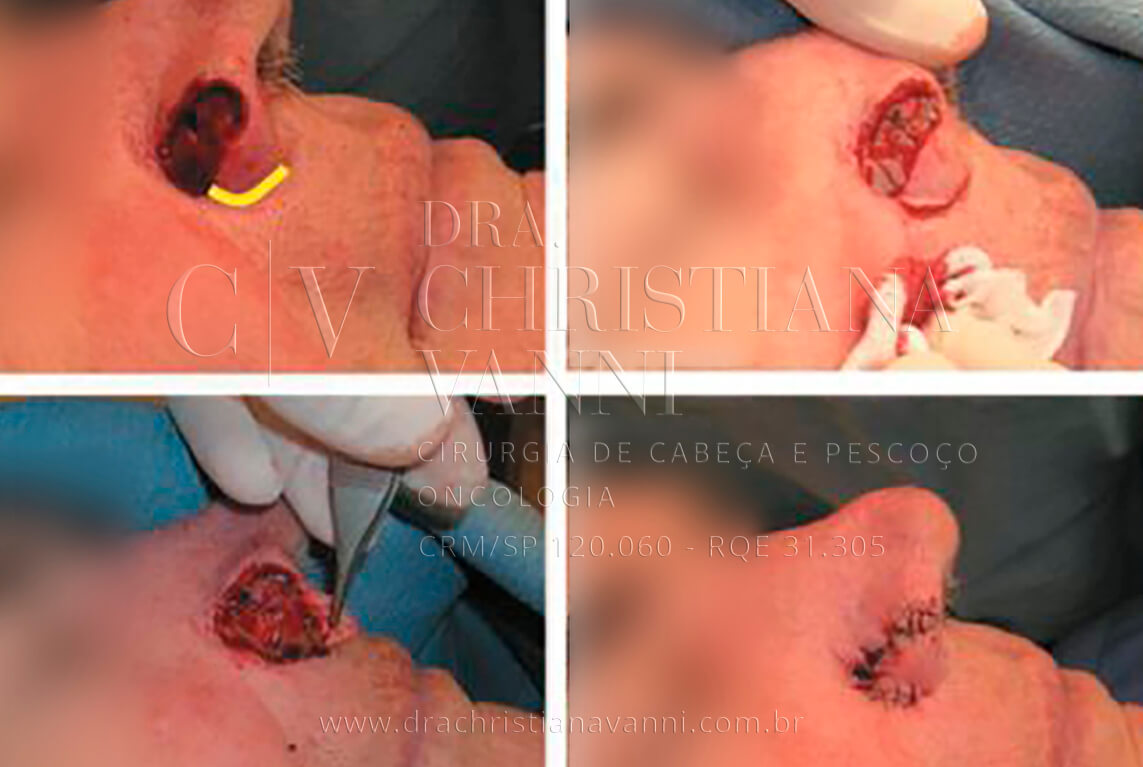 cirurgia de câncer de pele no nariz