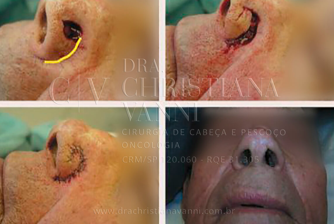 Cirurgia de câncer de pele no nariz