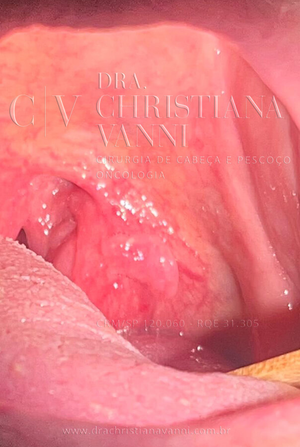 Foto de carcinoma espinocelular (CEC) - Câncer de garganta