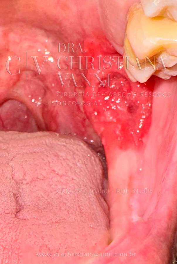 Foto de carcinoma espinocelular (CEC) - Câncer de orofaringe