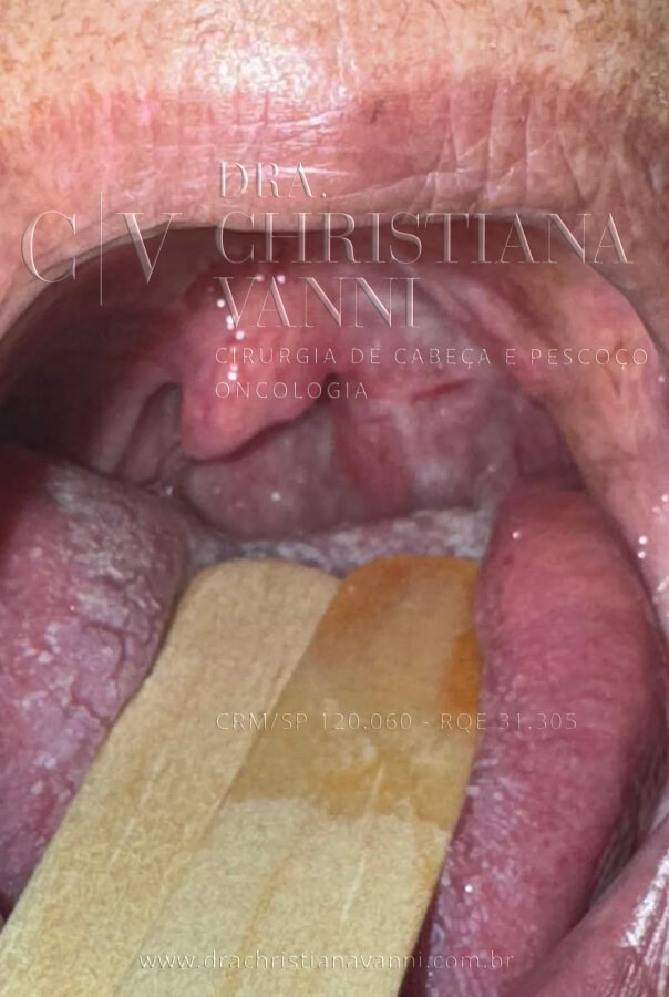 Foto de carcinoma espinocelular (CEC) - Câncer de amigdala