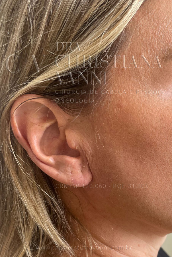 Cicatriz de Parotidectomia com Acesso Retroauricular (Lado Operado)