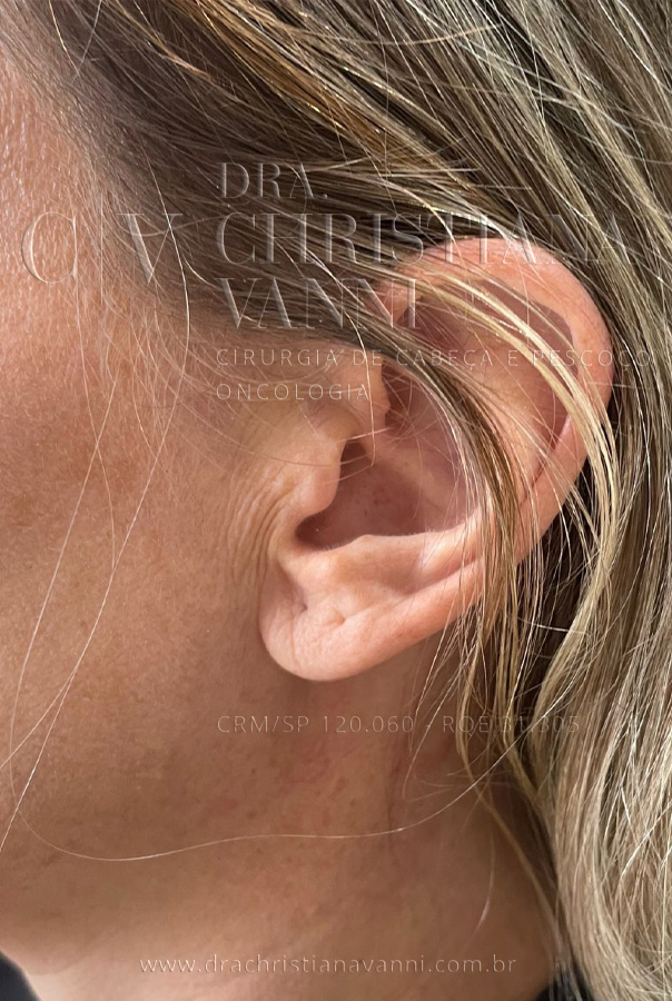 Cicatriz de Parotidectomia com Acesso Retroauricular (Lado Não Operado)