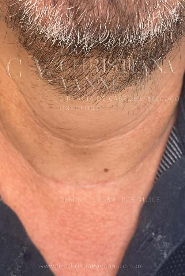 Cicatriz Tireoide e Paratireoide