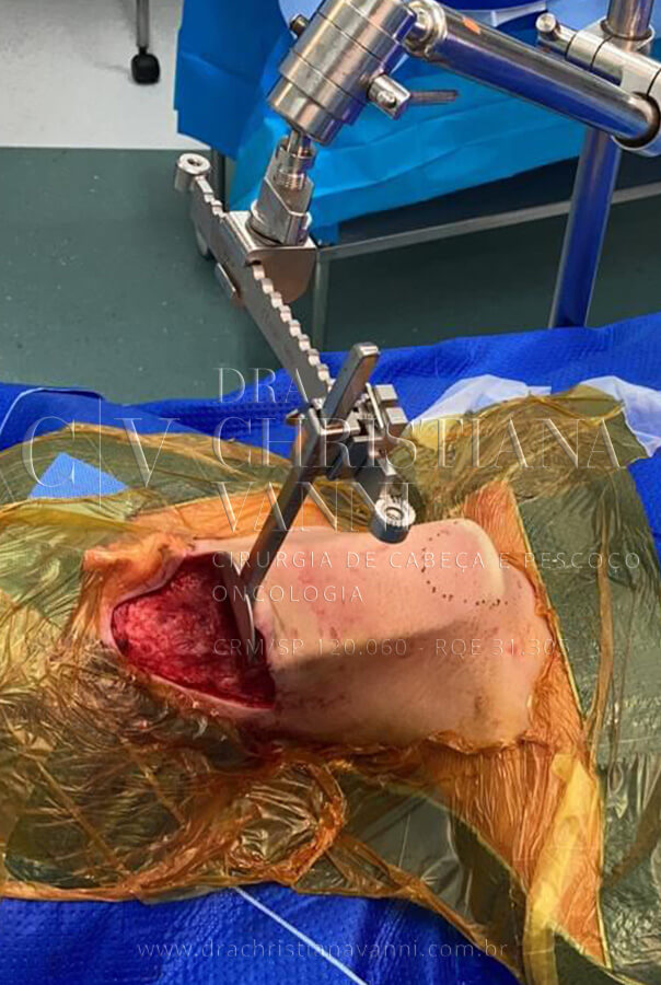 Cirurgia Robótica de Tireoide Metástastica com Acesso Retroauricular