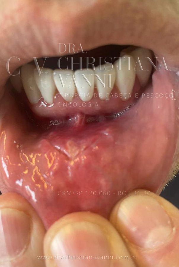 Cicatriz de Cirurgia para tireoidectomia trans vestibular