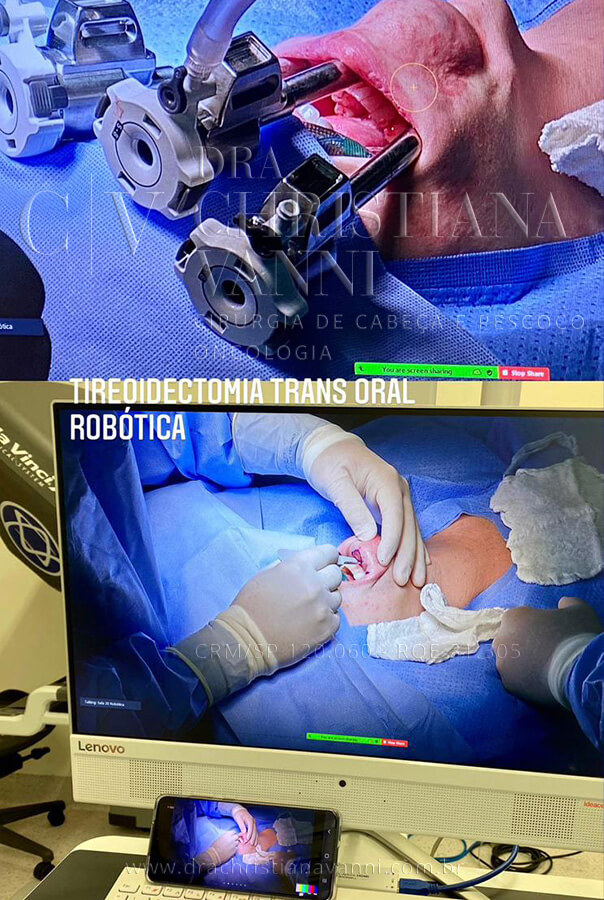 Cirurgia Robótica de Tireoide por Acesso Vestibular (pela Boca)