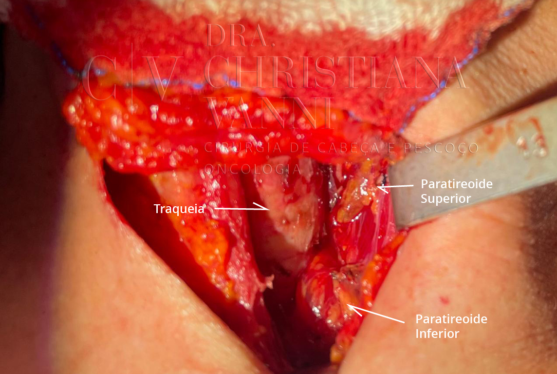 Cirurgia Convencional de Tireoide