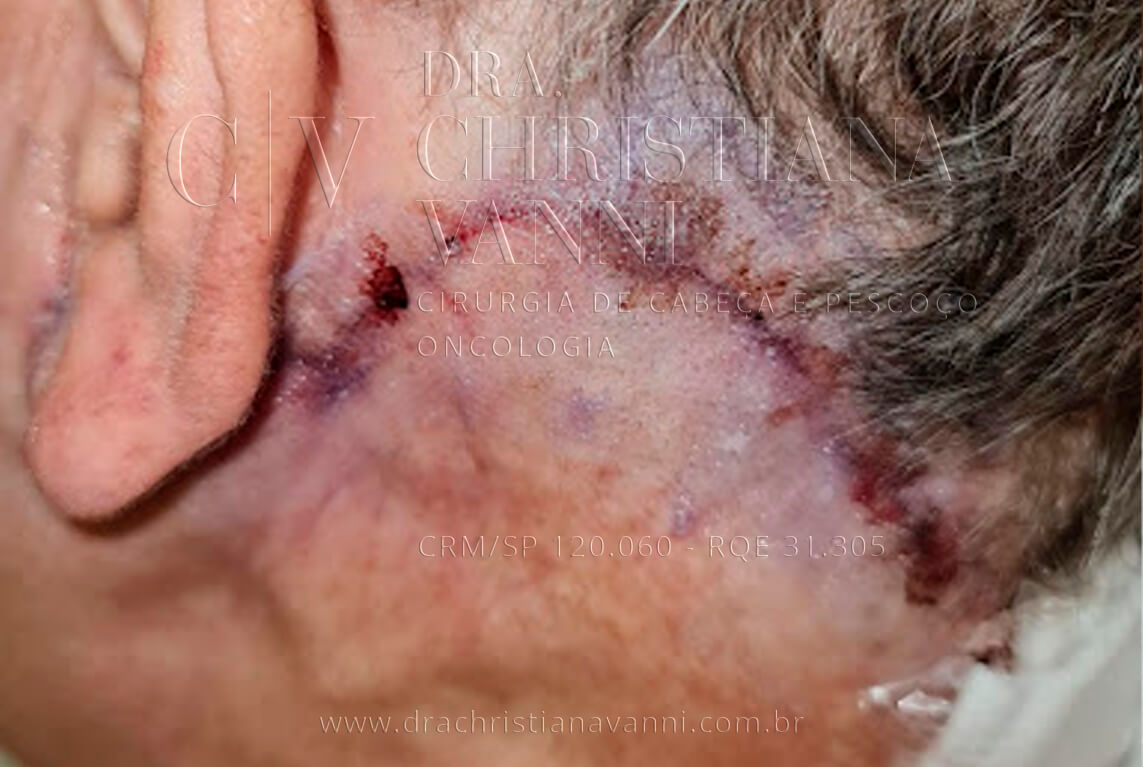 foto de adesivo para fechar a incisão no pós cirúrgico (sem pontos externos)