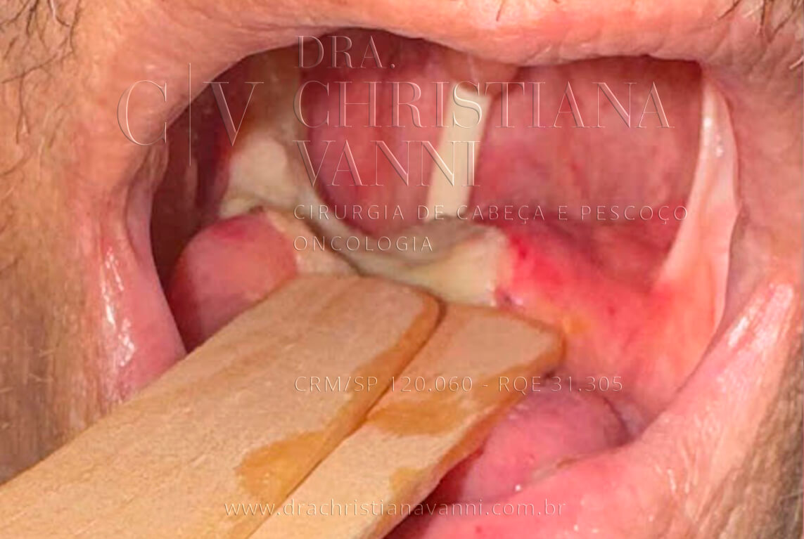 área cicatricial de pós glossectomia por cirurgia robótica