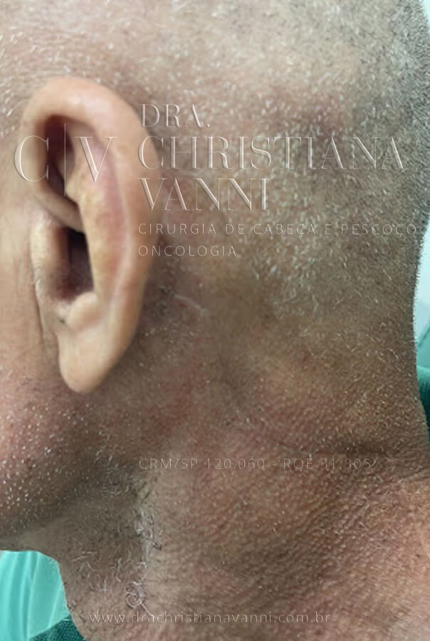 foto de cicatriz de cirurgia por acesso retroauricular (15 dias) foto de cicatriz de cirurgia por acesso retroauricular (1mês)