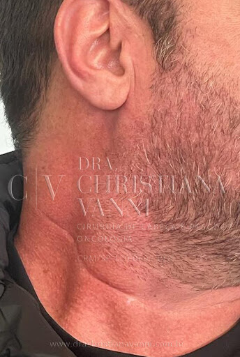 foto de cicatriz de esvaziamento cervical (lateral do pescoço cirurgia aberta)