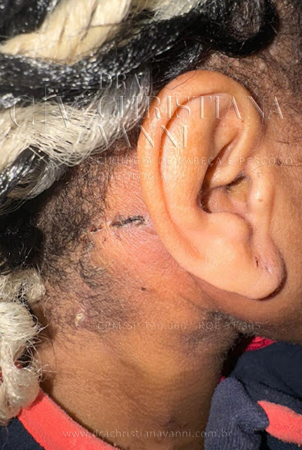 cicatriz pós cirúrgico por acesso retroauricular (1 semana)