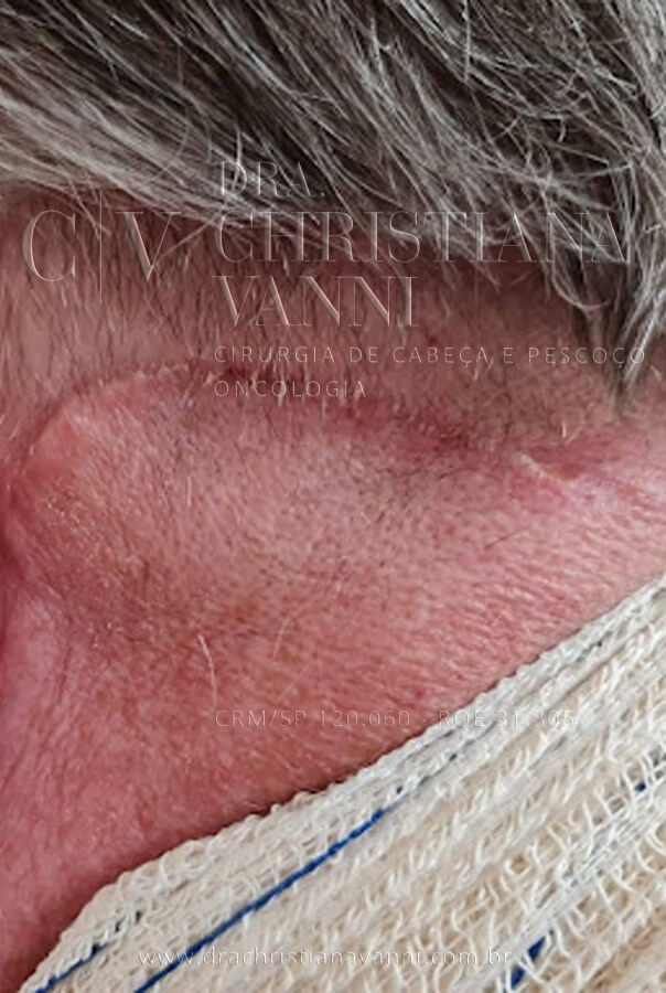foto de cicatriz de cirurgia por acesso retroauricular (15 dias)