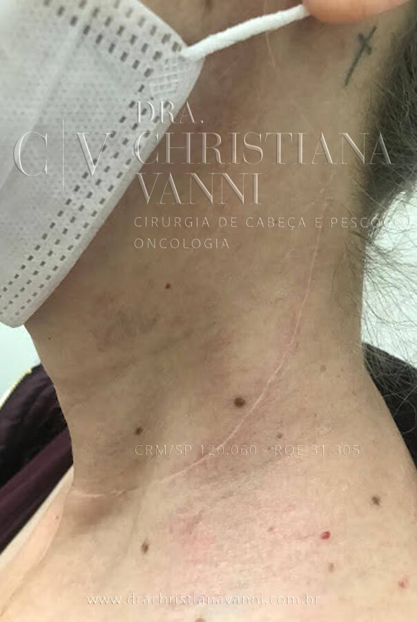 foto de cicatriz de tireoide com esvaziamento cervical (cicatriz taça cirurgia aberta)