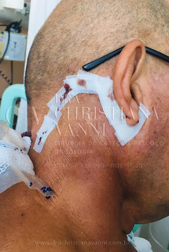 cicatriz de tireoide por cirurgia robótica com acesso retroauricular