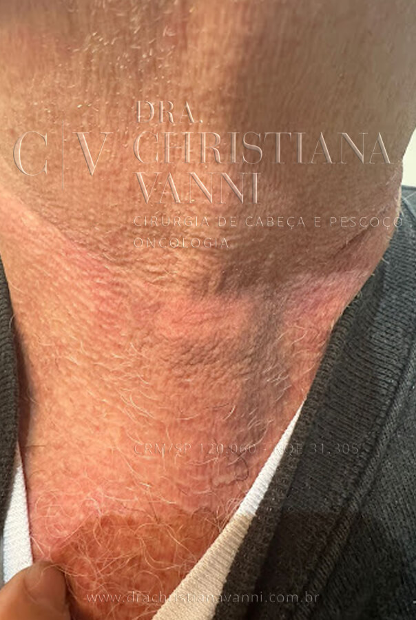 foto de cicatriz de tireoide na dobra natural da pele (1 mês após cirurgia aberta)