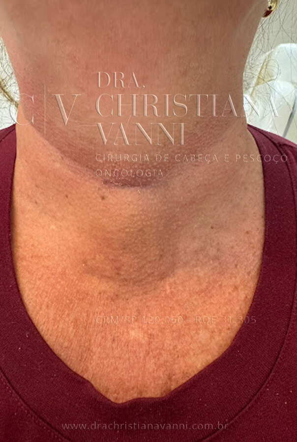 foto de cicatriz de tireoide na dobra natural da pele (1 mês após cirurgia aberta)