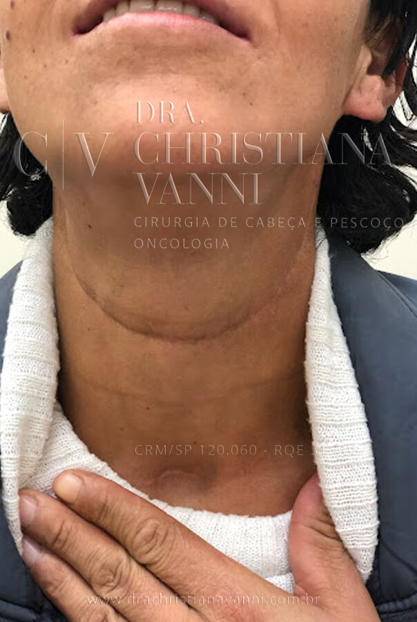 foto de cicatriz de tireoide com esvaziamento cervical (1 mês após cirurgia aberta)