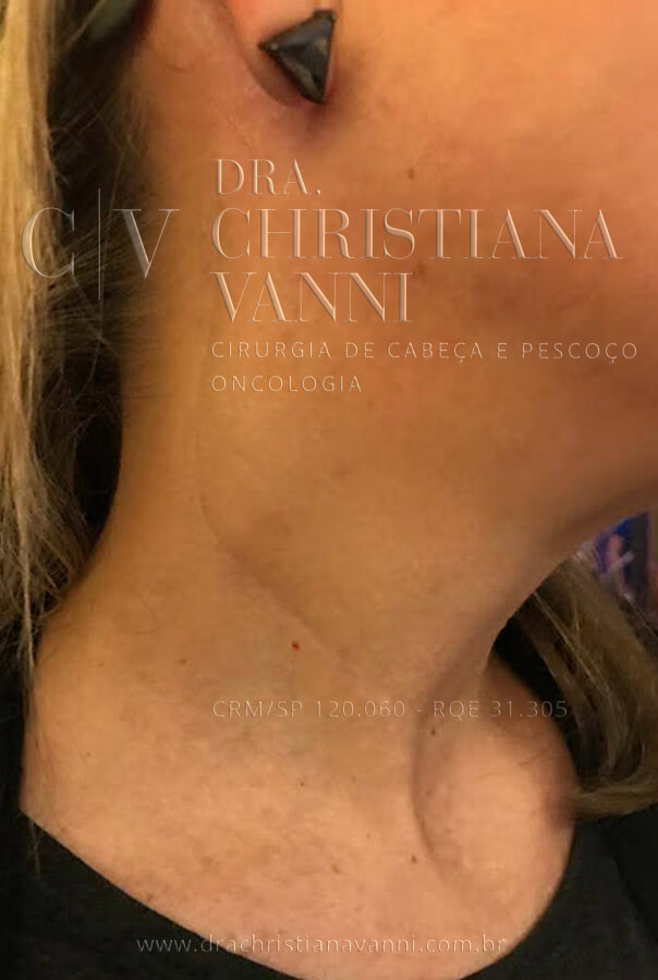 foto de cicatriz de tireoide com esvaziamento cervical (cicatriz taça cirurgia aberta)