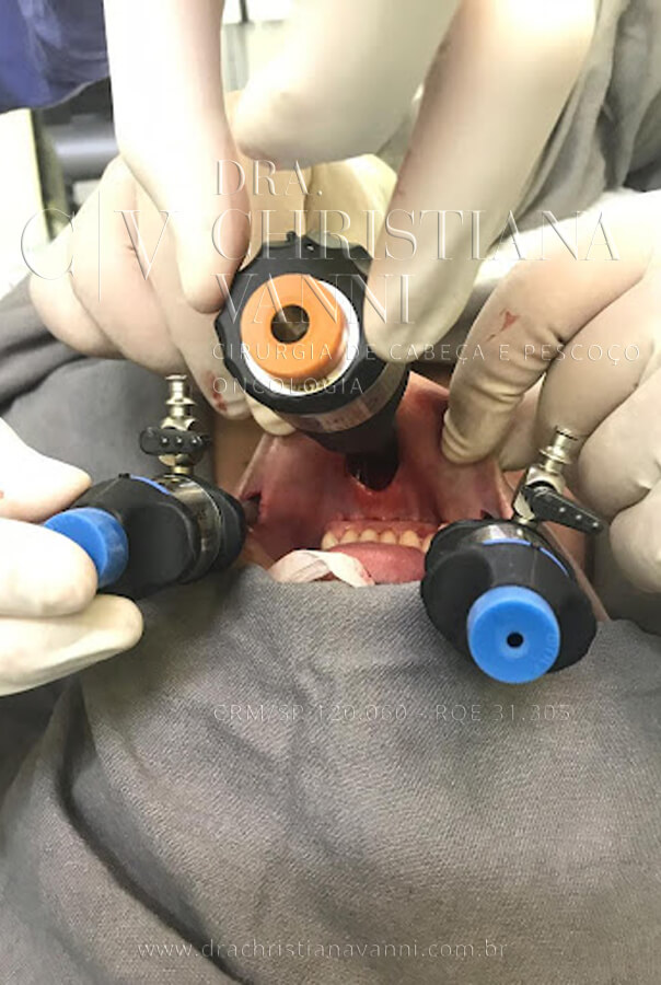 cirurgia por acesso vestibular (os instrumentos são inseridos através dos vestíbulos orais)