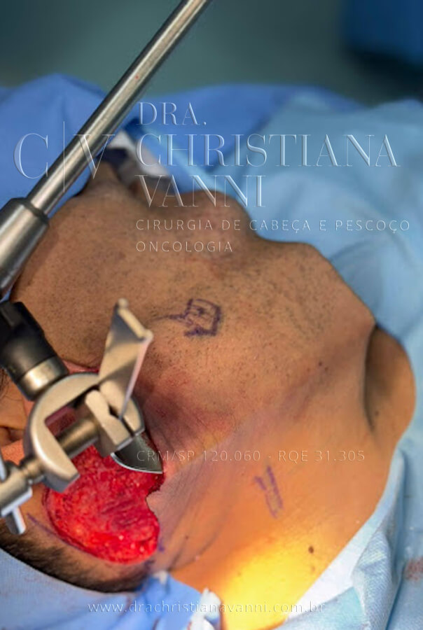 cirurgia robótica por acesso retroauricular