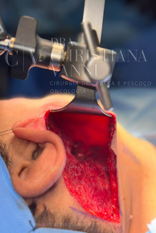 cirurgia robótica por acesso retroauricular